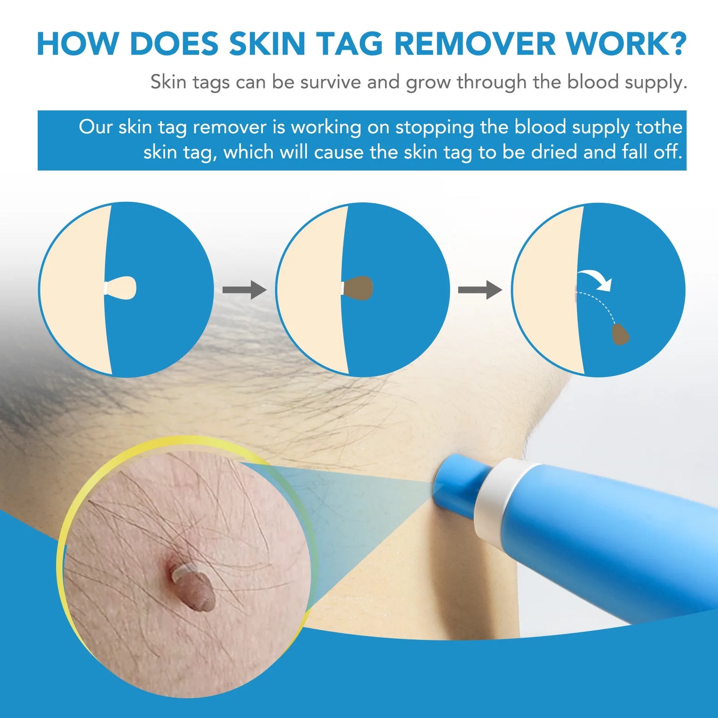 SmoothErase™ Skin Tag Solution