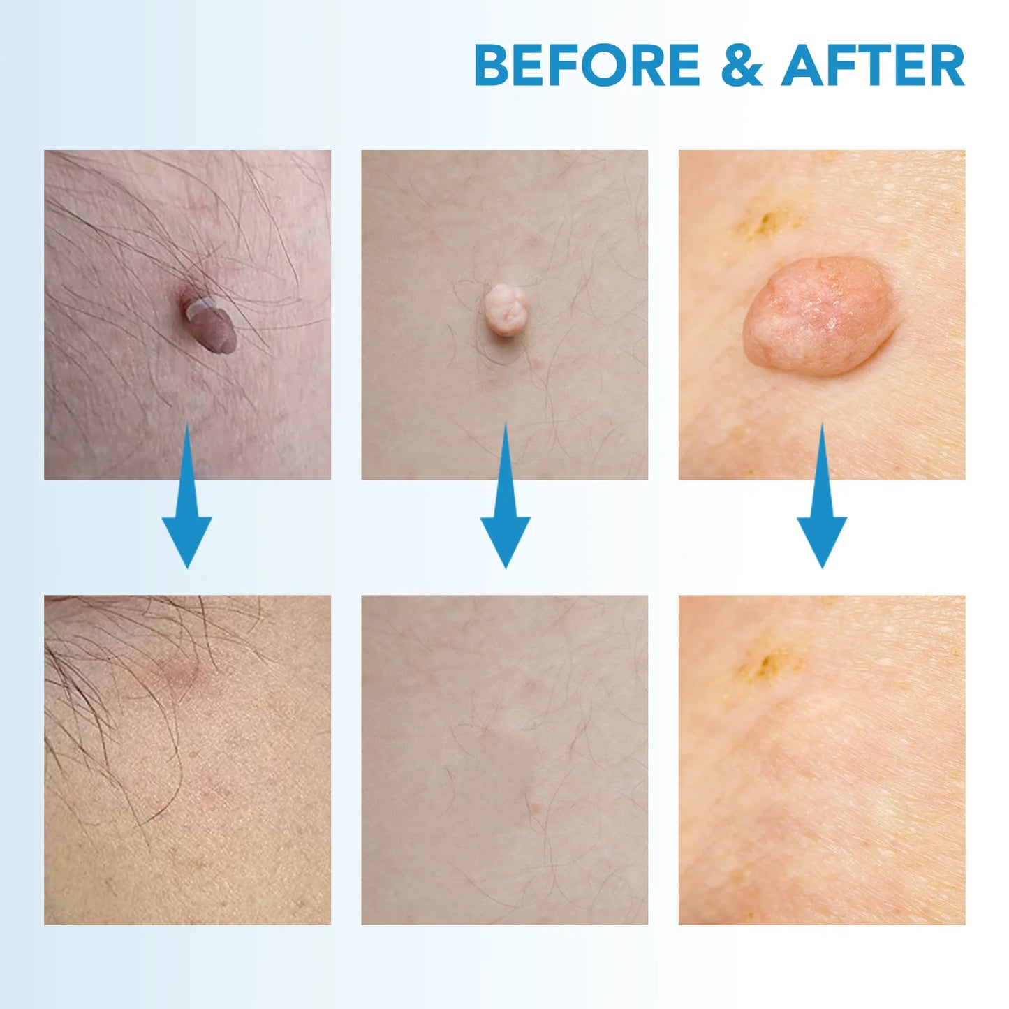 SmoothErase™ Skin Tag Solution