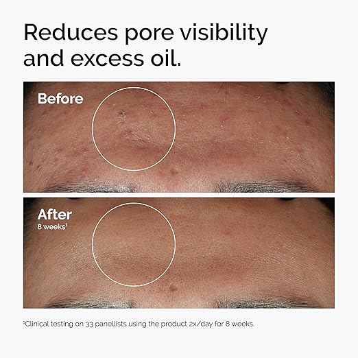 The Ordinary Niacinamide  Serum