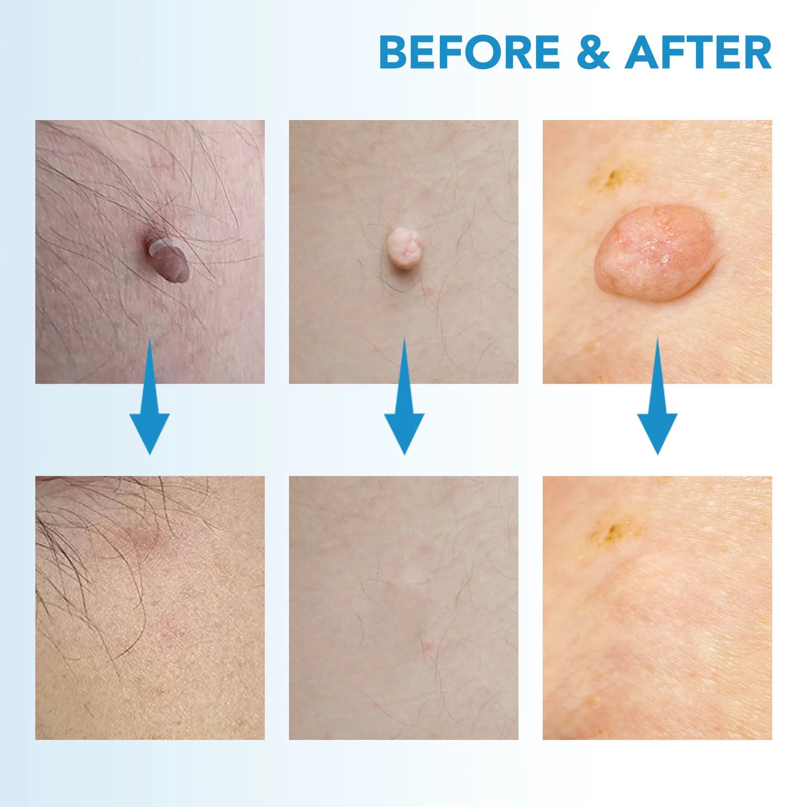 SmoothErase™ Skin Tag Solution