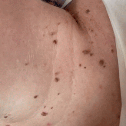 SmoothErase™ Skin Tag Solution
